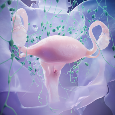 Gynaecological cancers