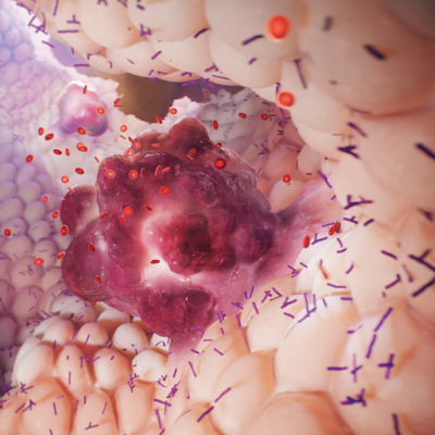 Gastro &amp; colorectal cancer