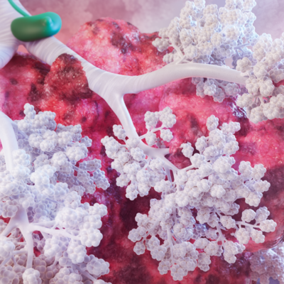 Lung cancer