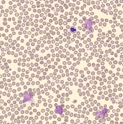 Fig. 2 Digital imaging (by a DI-60) revealing smudge cells.