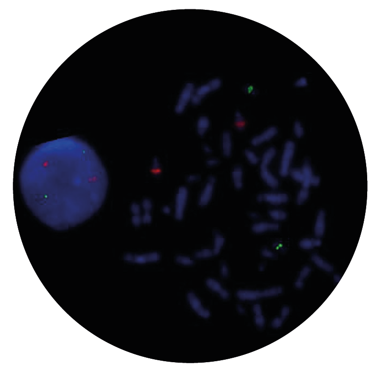 Fig. 1: FISH image of a PML::RARA fusion