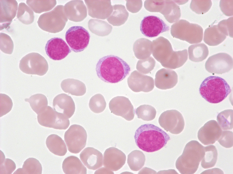 Prolymphocytes and lymphocytes Prolymphocytes and lymphocytes