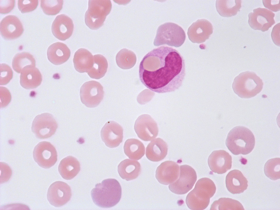 Auto-immune haemolytic anaemia (AIHA) Auto-immune haemolytic anaemia (AIHA)