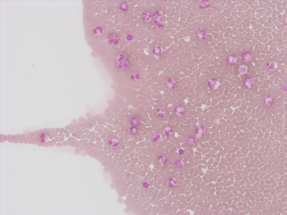 Disturbed cell distribution Disturbed cell distribution