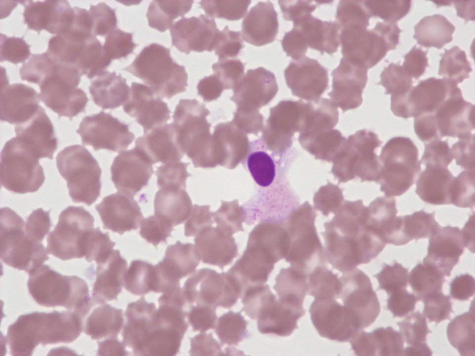 Degraded granulocytes Degraded granulocytes