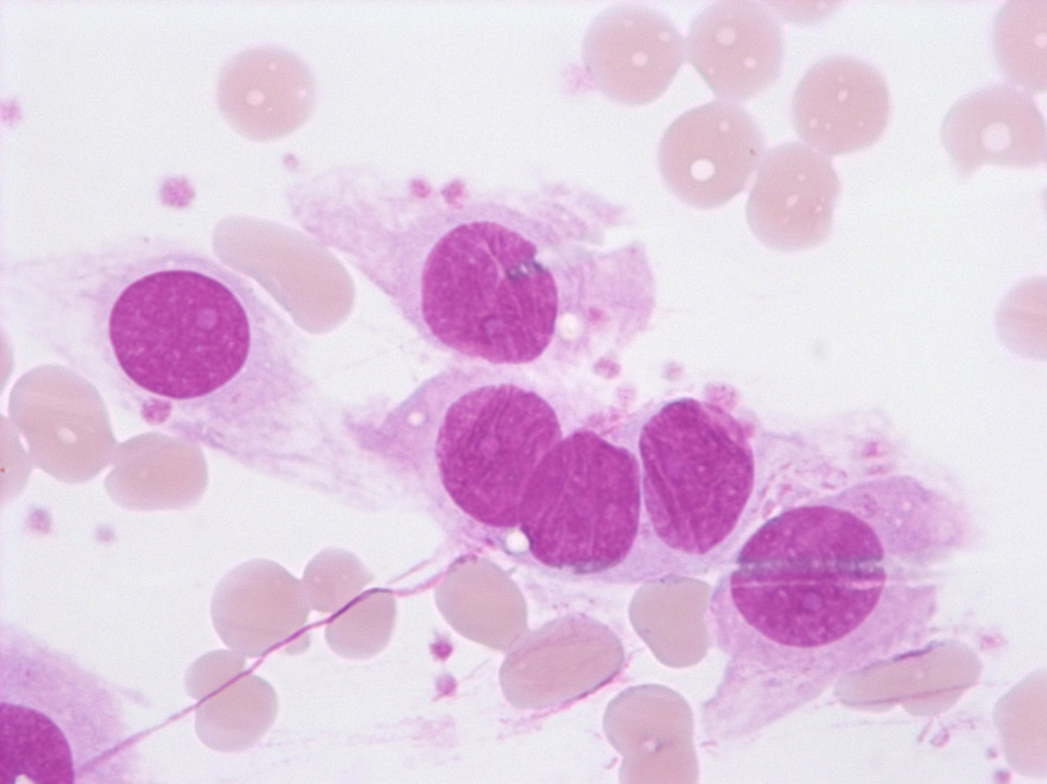 Endothelial cells on blood film Endothelial cells on blood film