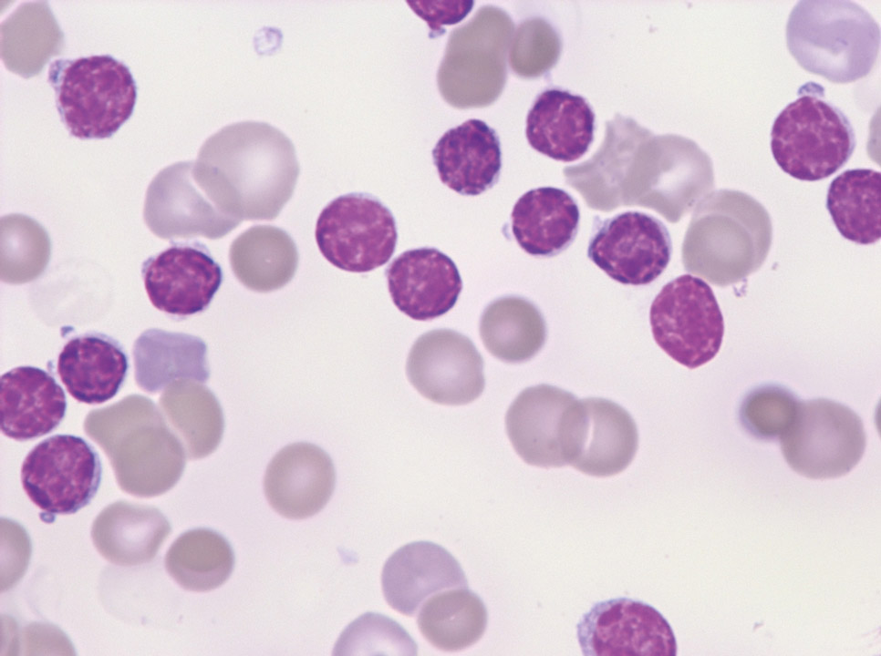 Auto-immune haemolytic anaemia Auto-immune haemolytic anaemia