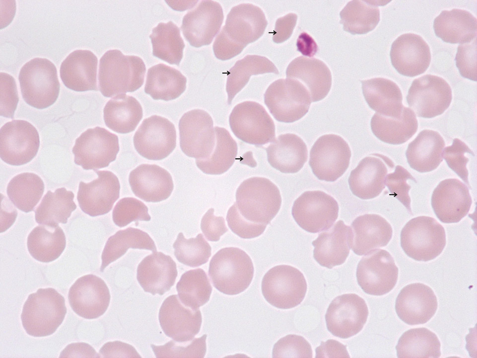 Schistocytes and thrombocytopenia