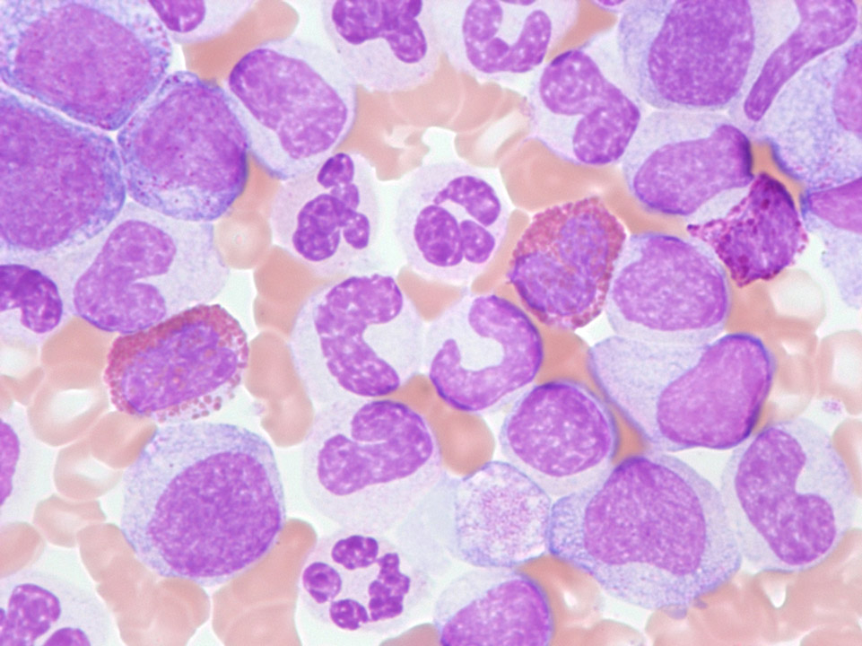 Chronic myelogenous leukaemia (CML) Chronic myelogenous leukaemia (CML)