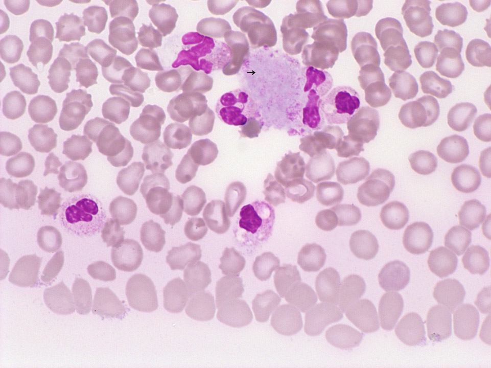 Platelet aggregates Platelet aggregates