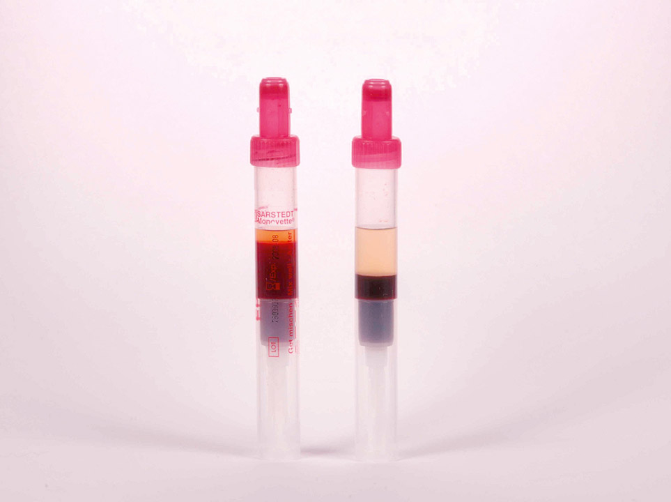 Erythrocytosis Erythrocytosis