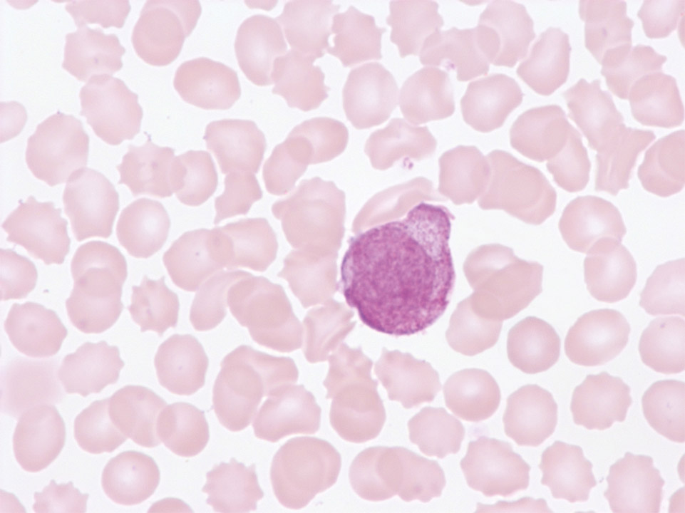 Atypical promyelocyte in peripheral blood