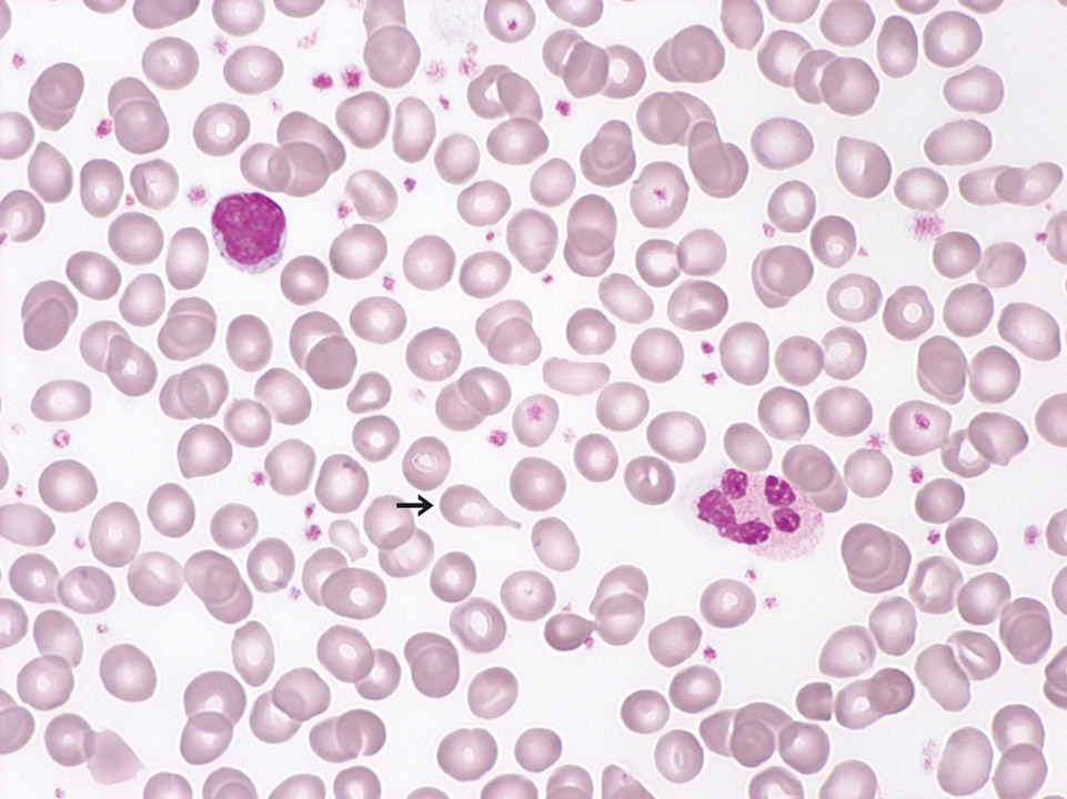 Primary myelofibrosis (PMF) in prefibrotic stage Primary myelofibrosis (PMF) in prefibrotic stage