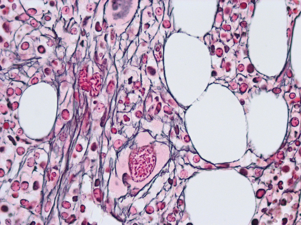 Primary myelofibrosis (PMF) in bone marrow histology