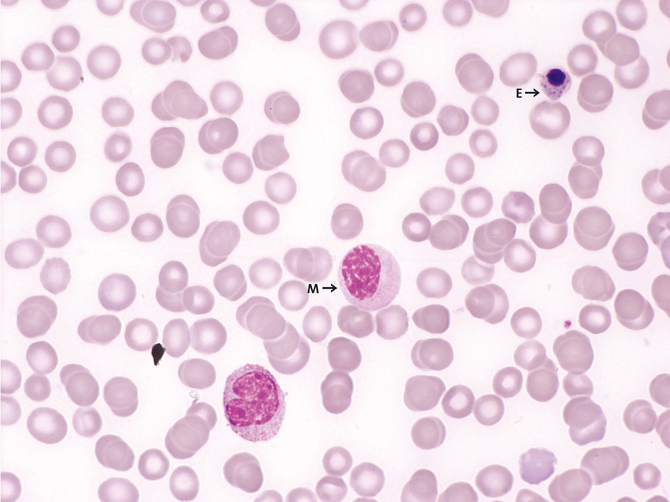 Peripheral blood of a patient with breast cancer and bone metastases