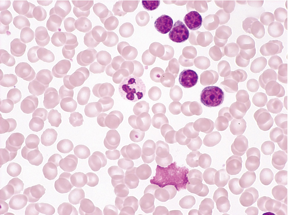 Peripheral blood showing a typical B-CLL Peripheral blood showing a typical B-CLL