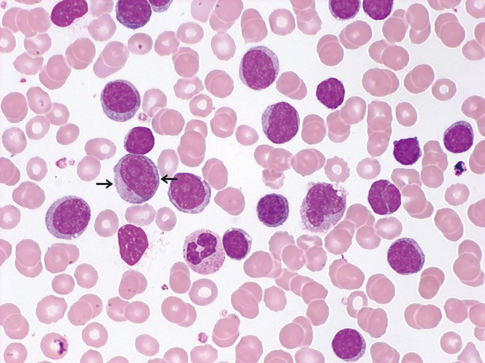 Chronic lymphocytic leukaemia / prolymphocytic leukaemia Chronic lymphocytic leukaemia / prolymphocytic leukaemia