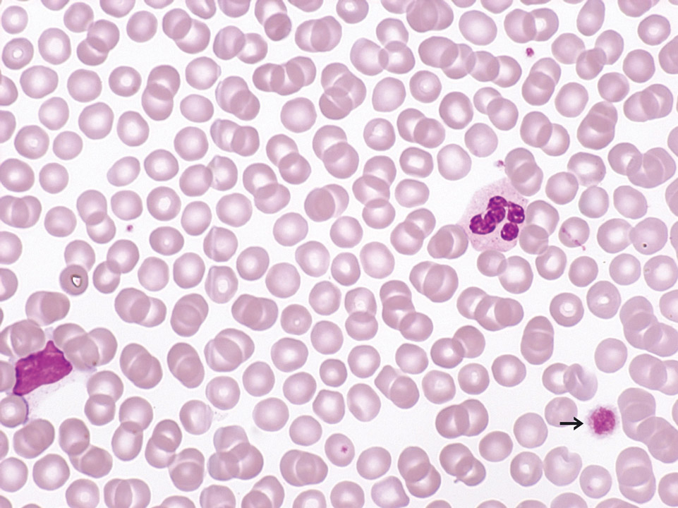 Peripheral blood of a patient with B-CLL