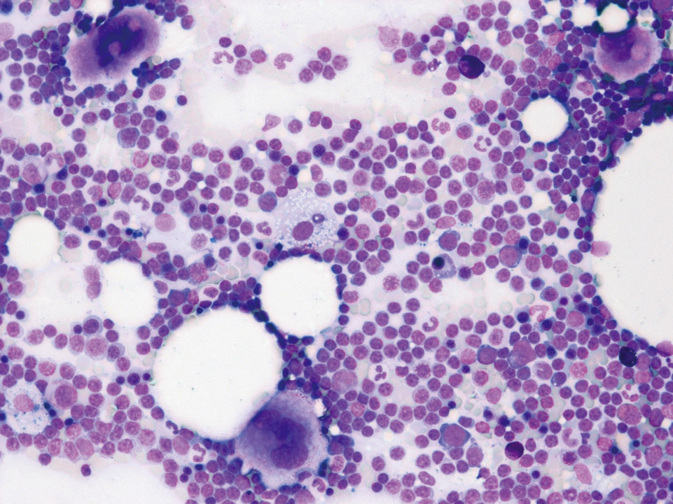 Dense infiltration of bone marrow by B-CLL Dense infiltration of bone marrow by B-CLL
