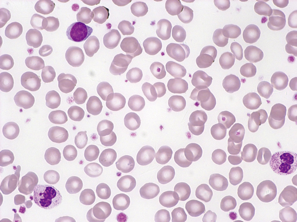 Peripheral blood of a patient with ET showing an isolated thrombocytosis Peripheral blood of a patient with ET showing an isolated thrombocytosis