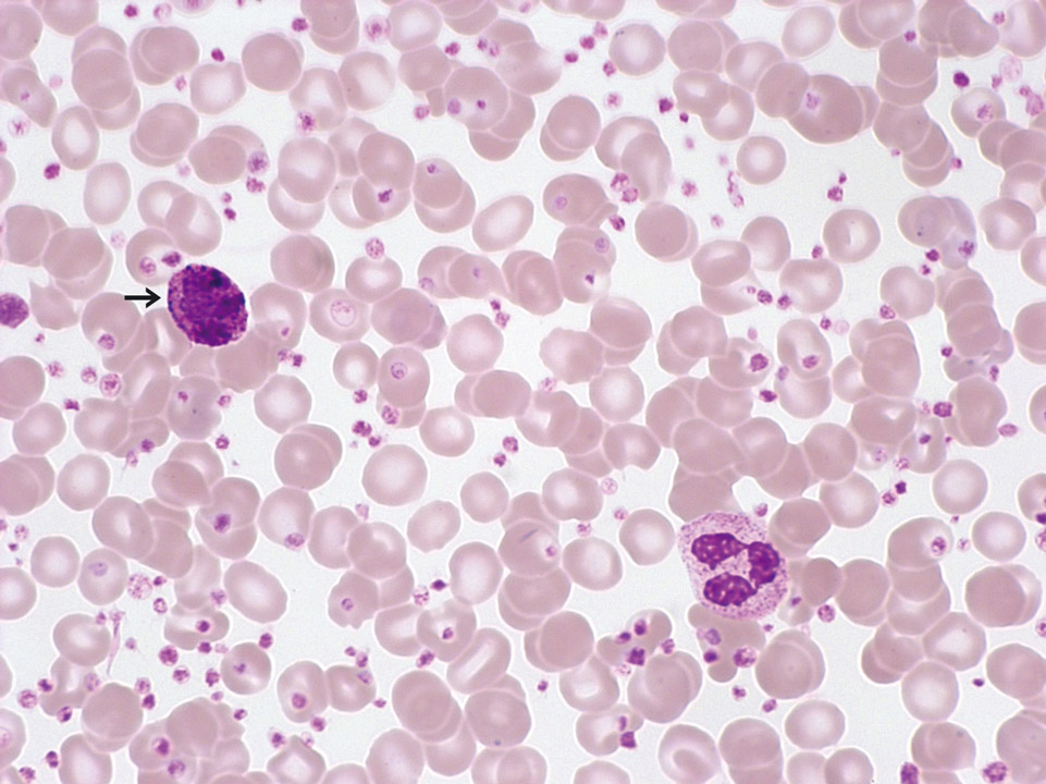 Peripheral blood of a patient with CML