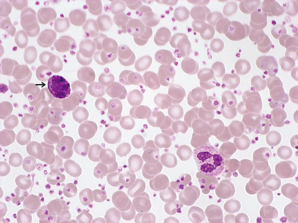 Peripheral blood of a patient with CML Peripheral blood of a patient with CML