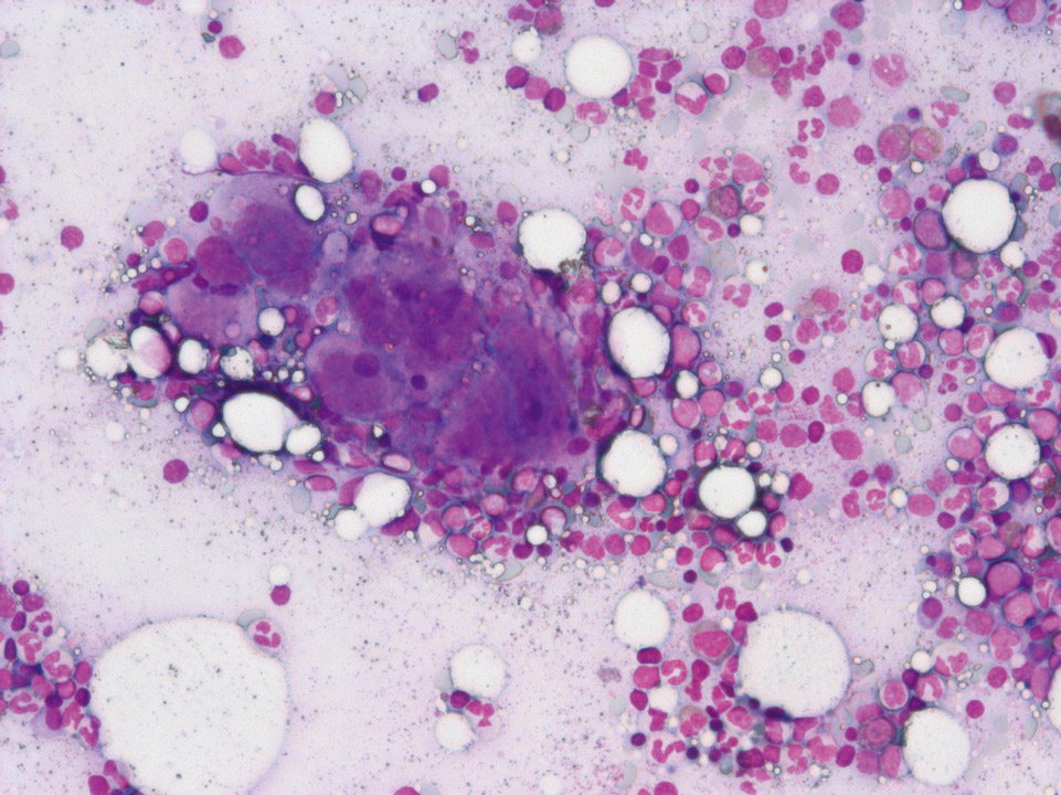 Exceptionally large megakaryocytes Exceptionally large megakaryocytes