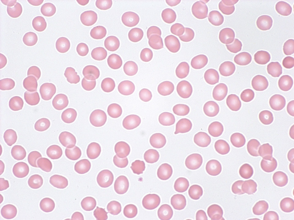 Pancytopenia (tricytopenia) in peripheral blood