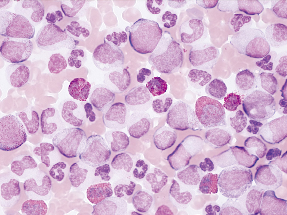 Peripheral blood of a patient with CML