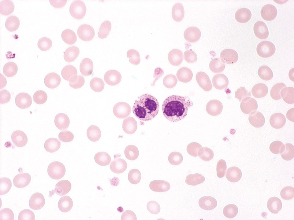 Peripheral blood of a patient with MDS Peripheral blood of a patient with MDS
