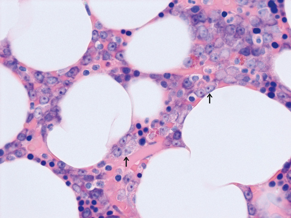 Plasma cells in bone marrow of a patient with multiple myeloma