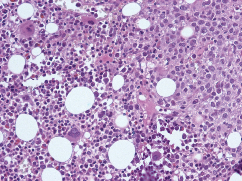 Bone marrow infiltrated by a diffuse large B-cell lymphoma