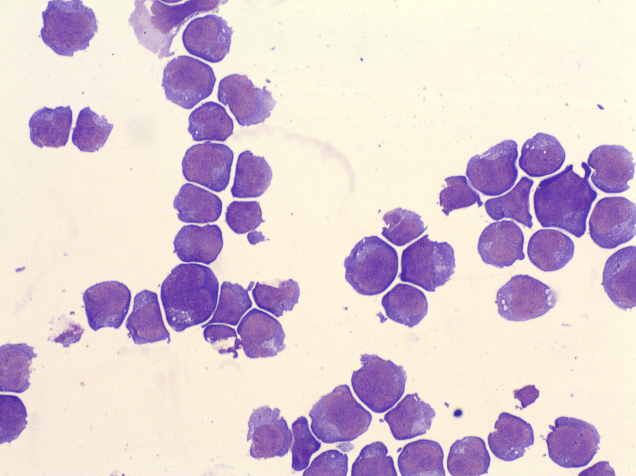 CSF lymphoma cells