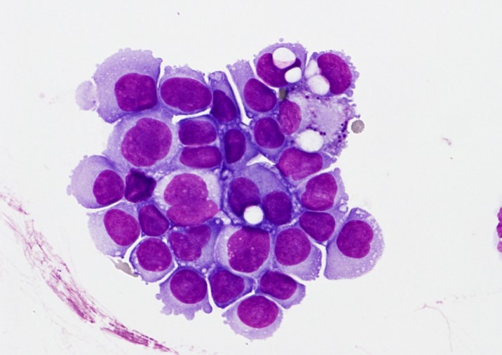 CSF of a breast cancer patient