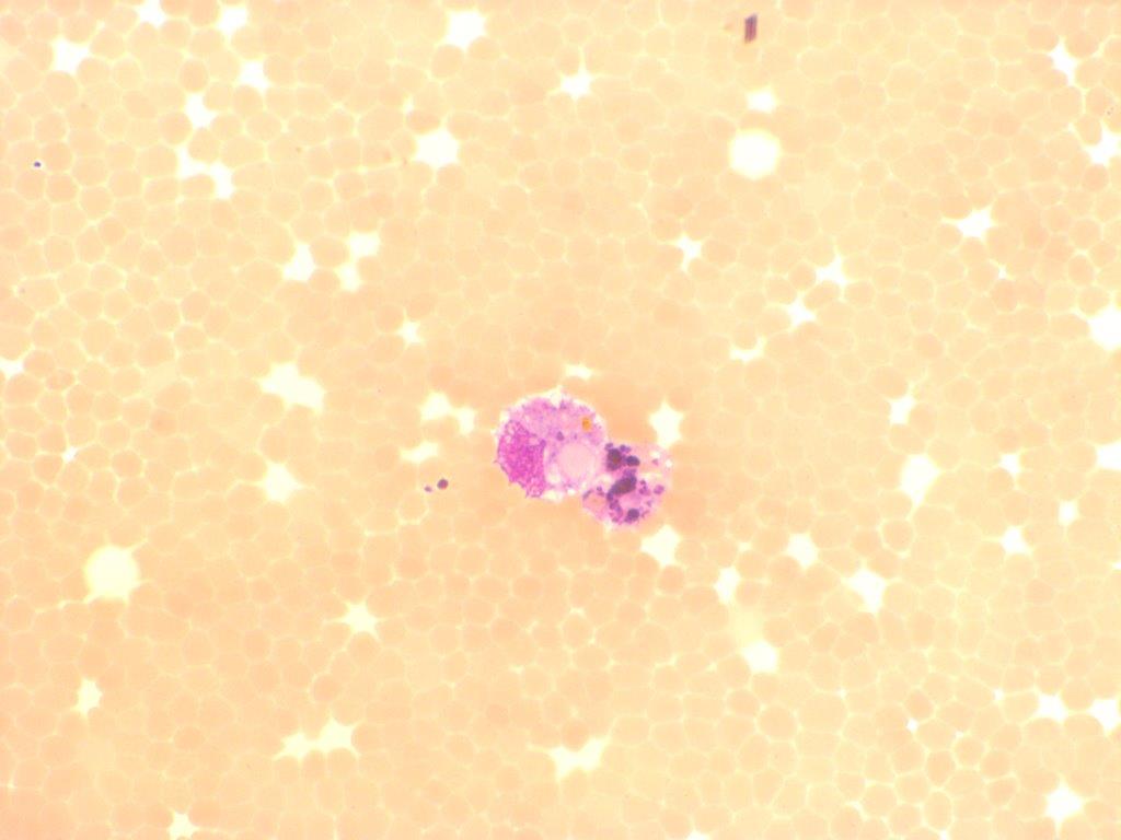 CSF with RBC erythrophages and siderophages