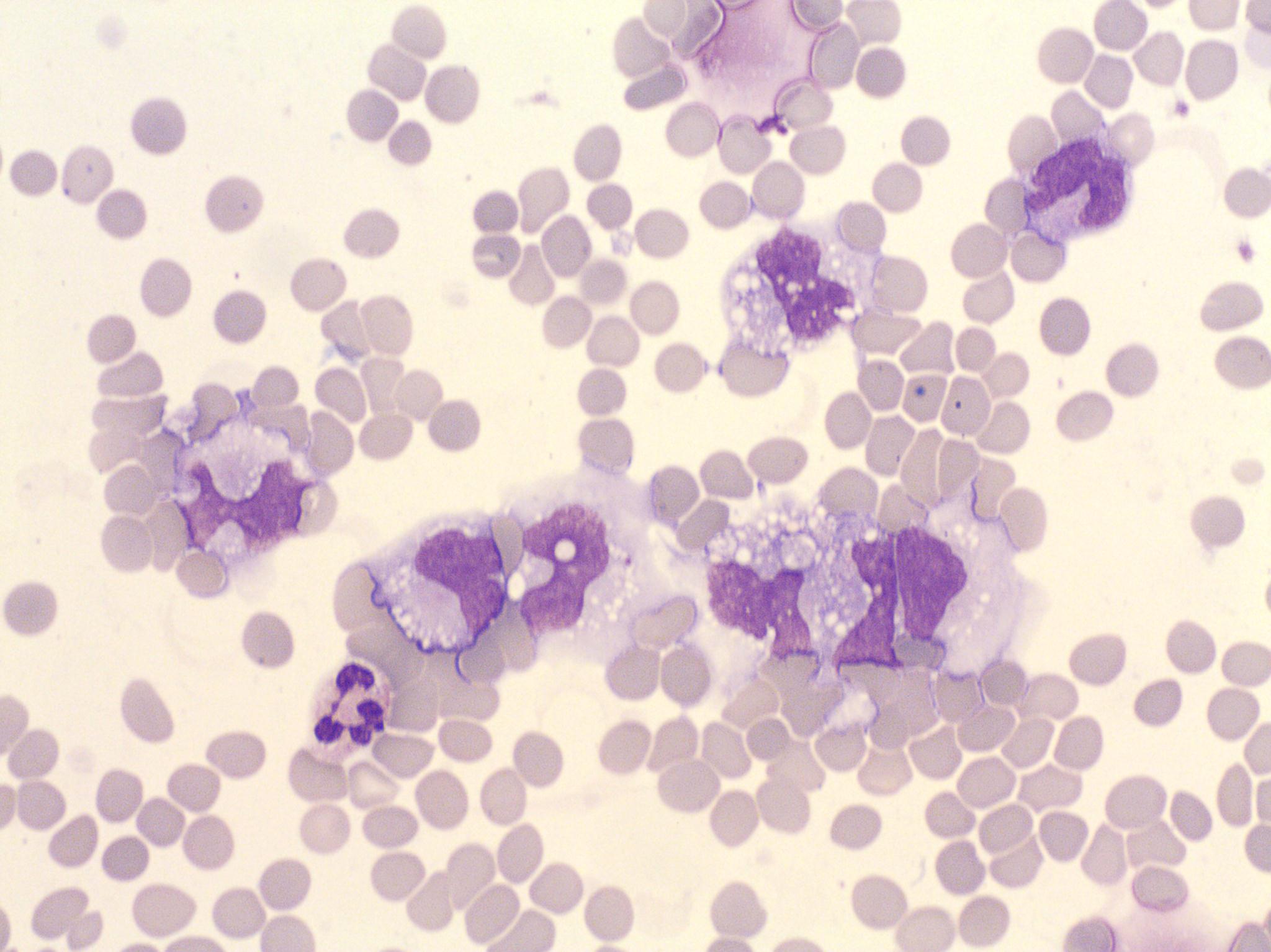 CSF with macrophages