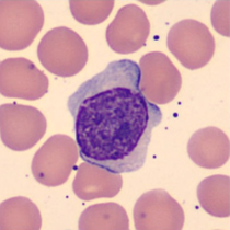 Prolymphocyte Prolymphocyte